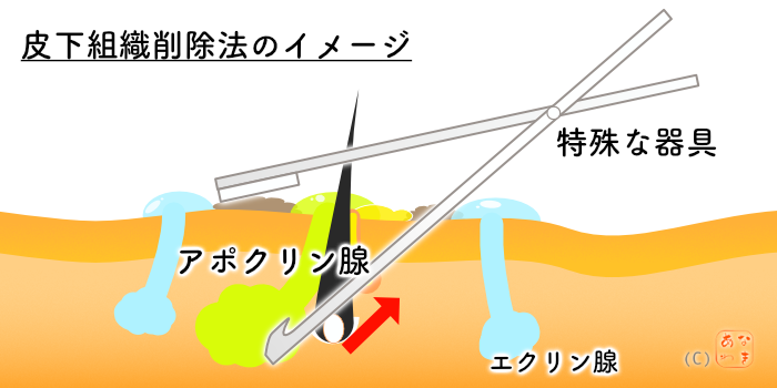 皮下組織削除法のイメージ